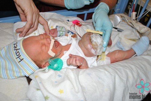 A baby in the NICU with an omphalocele. Logo: Houston moms Blog. 