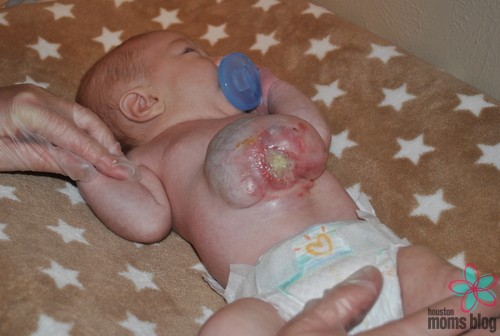 A young baby with an omphalocele. Logo: Houston moms Blog. 