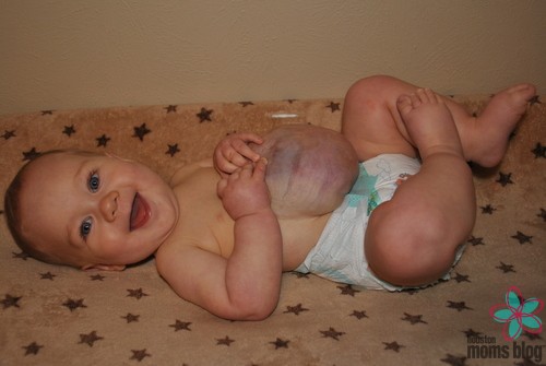 A smiling baby with an Omphalocele. Logo: Houston moms Blog. 