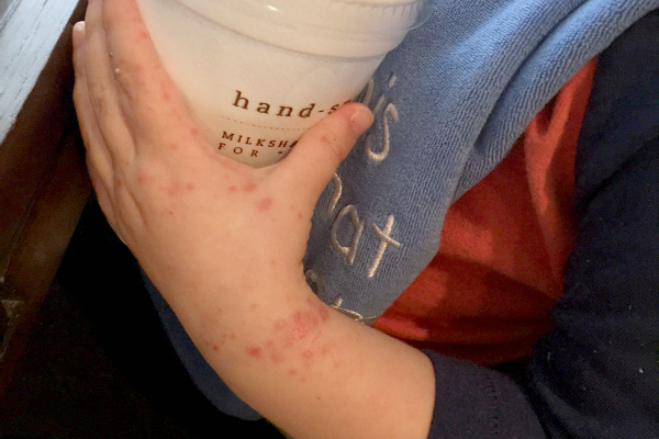 A rash on a child's hand and arm. 