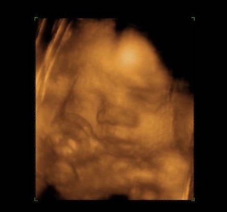 3D ultrasound image of a baby in the womb